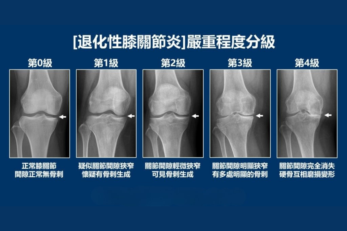 退化性關節炎分級