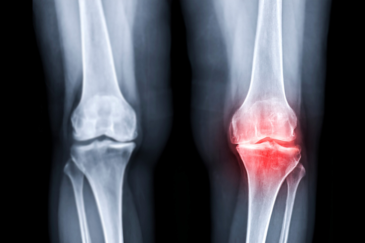 退化性關節炎，也叫骨關節炎，是一種因關節長期使用、軟骨逐漸磨損所造成的不適症狀。